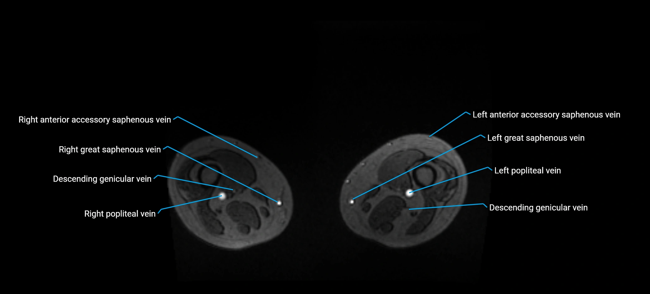 MRV abdomen pelvis & lower limb axial cross sectional anatomy labelled MRI image 324.webp